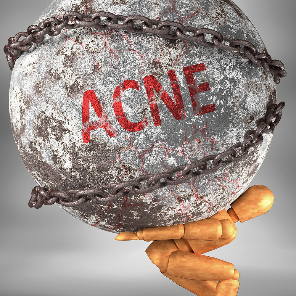 Acnee și sănătate mintală: cum influențează stresul pielea