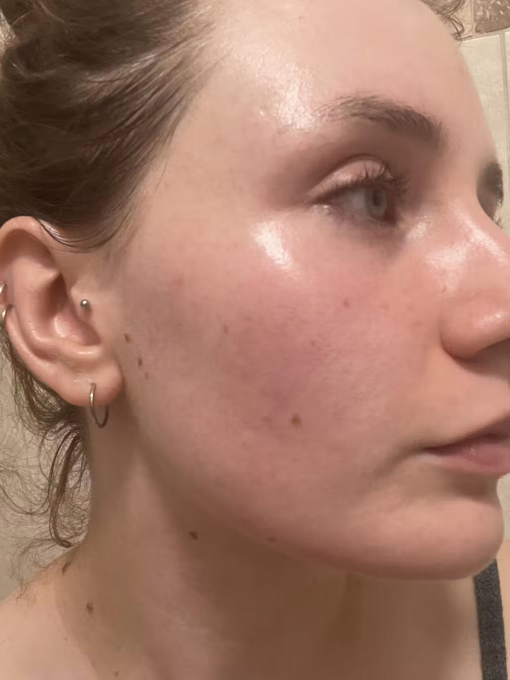 acne RO keep