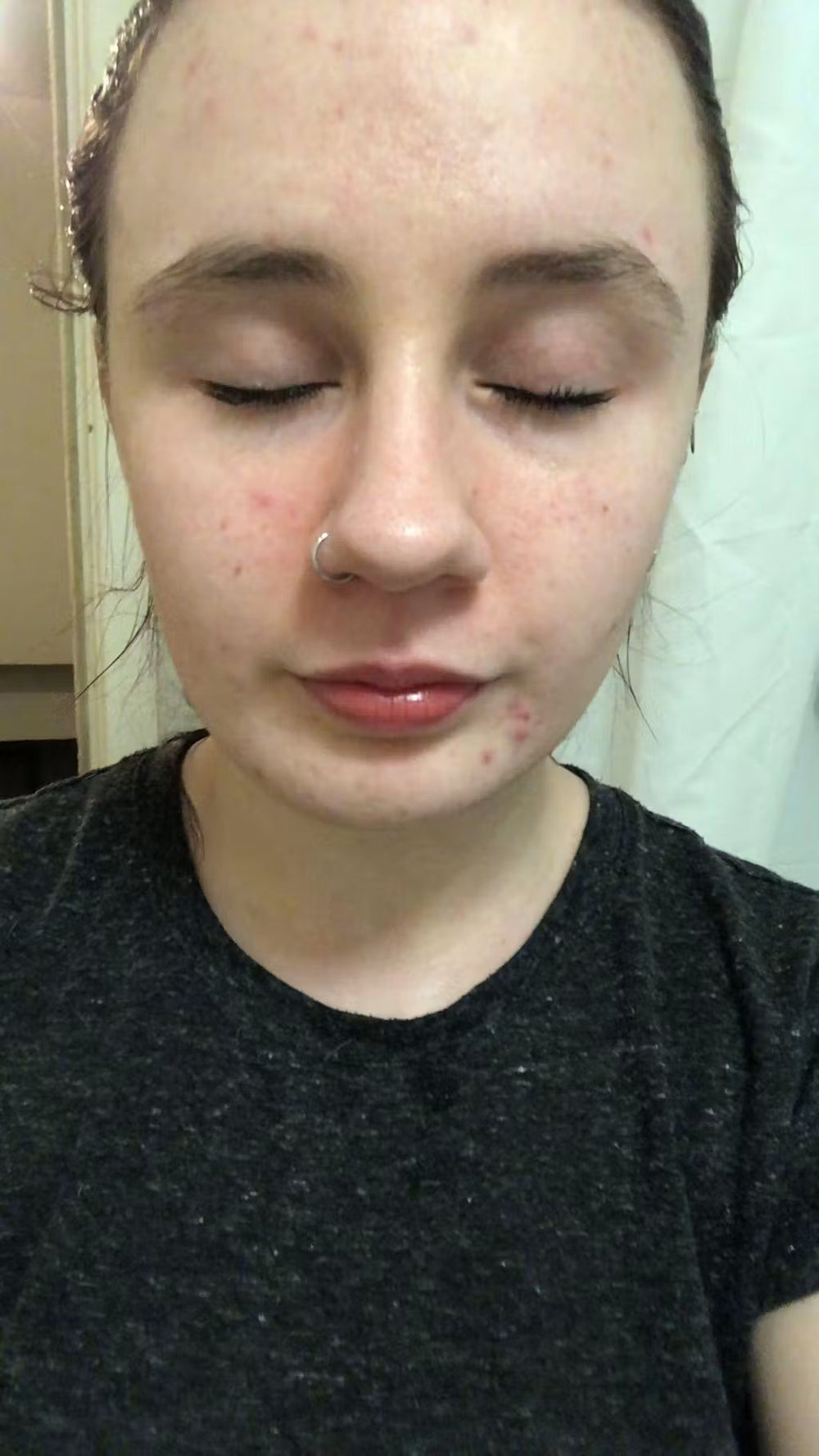 acne RO keep